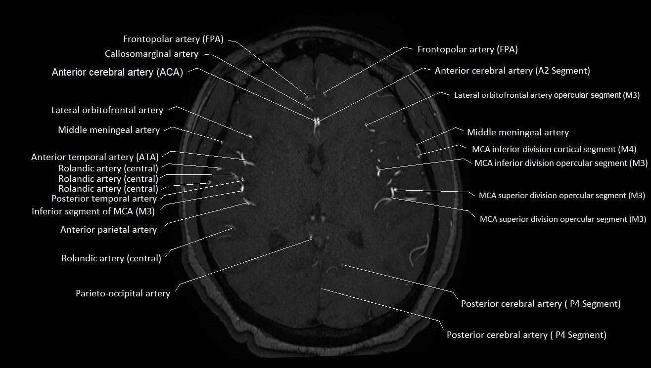 MRA brain (cerebral arteries) anatomy axial 3T image 29.webp